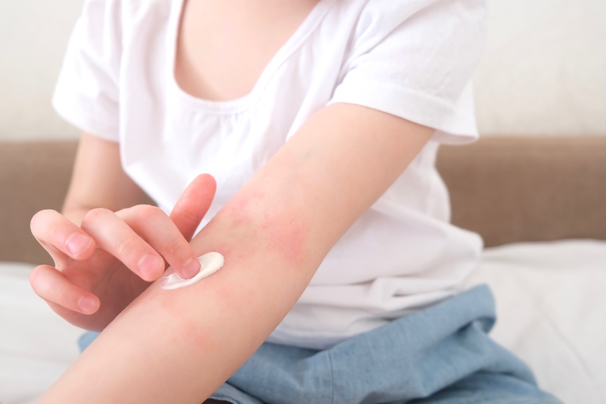 How Can Ayurveda Help Soothe Eczema-Prone Skin